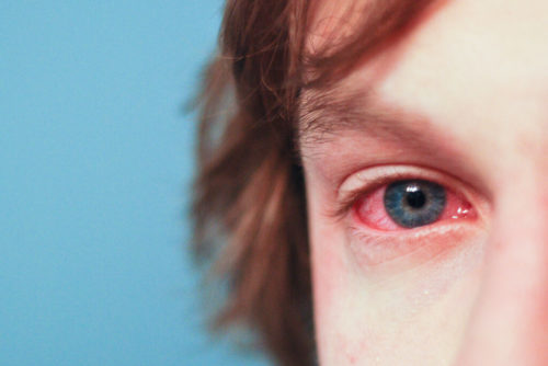 Реакция слизистой глаза на аллергены