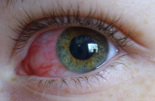 Воспаление глаза при вирусах