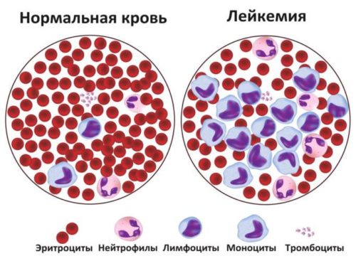 сравнение нормальной крови и лейкемии
