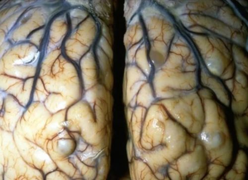 Глисты в мозге человека