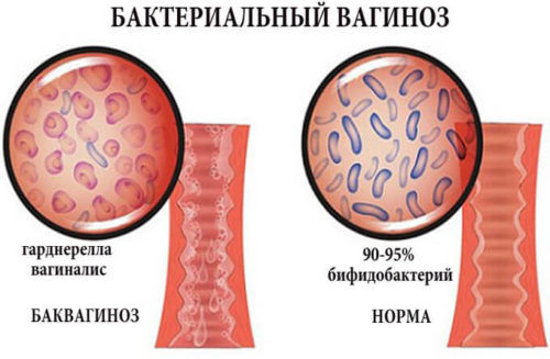 бактериальный вагиноз