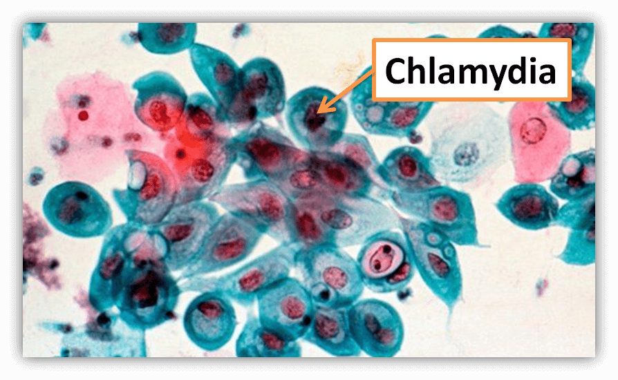 Живут хламидии. Хламидии - возбудители урогенитальных инфекций. Хламидия трахоматис под микроскопом. Возбудитель хламидии микробиология. Урогенитальный хламидиоз микроскопия.