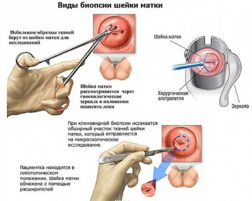 биопсия шейки матки
