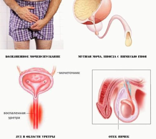 Симптомы хладимиоза у мужчин