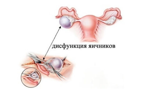 дисфункция яичников