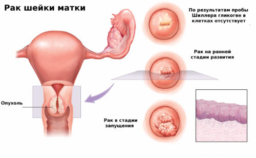 рак шейки матки из-за ВПЧ